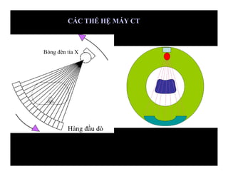 Hàng đầu dò
Bóng đèn tia X
CÁC THẾ HỆ MÁY CT
 