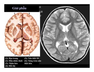 (1): Bao trong
(2): Đầu nhân đuôi
(3): Nhân bèo
(4): Đồi thị
1
2
3
4
5
6
(5): Não thất III
(6): Sừng trán não
thất bên
Giải phẫu
2
3
4
5
6
1
 