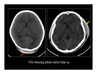Tổn thương phần mềm hộp sọ
 