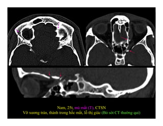 Nam, 25t, mù mắt (T), CTSN
Vỡ xương trán, thành trong hốc mắt, lỗ thị giác (Bỏ sót CT thường qui)
 