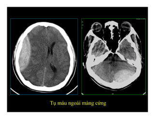 Tụ máu ngoài màng cứng
 