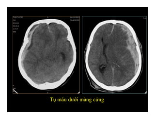Tụ máu dưới màng cứng
 
