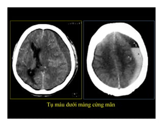 Tụ máu dưới màng cứng mãn
 