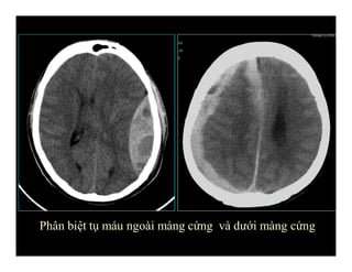 Phân biệt tụ máu ngoài màng cứng và dưới màng cứng
 