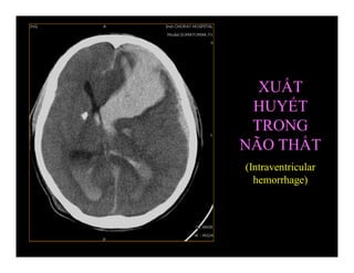 XUẤT
HUYẾT
TRONG
NÃO THẤT
(Intraventricular
hemorrhage)
 