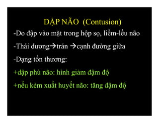 -Do đập vào mặt trong hộp sọ, liềm-lều não
-Thái dươngtrán cạnh đường giữa
-Dạng tổn thương:
+dập phù não: hình giảm đậm độ
+nếu kèm xuất huyết não: tăng đậm độ
DẬP NÃO (Contusion)
 