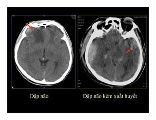 Dập não Dập não kèm xuất huyết
 