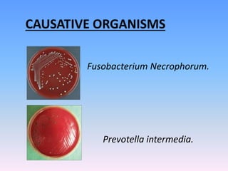 CAUSATIVE ORGANISMS
Fusobacterium Necrophorum.
Prevotella intermedia.
 