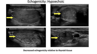 Thyroid Ultrasound and TIRADS | PPTX