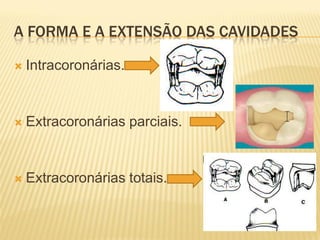 A FORMA E A EXTENSÃO DAS CAVIDADES

   Intracoronárias.


   Extracoronárias parciais.


   Extracoronárias totais.
 
