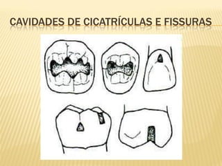 CAVIDADES DE CICATRÍCULAS E FISSURAS
 