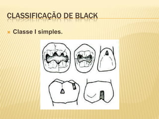 CLASSIFICAÇÃO DE BLACK
   Classe I simples.
 