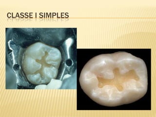 CLASSE I SIMPLES
 