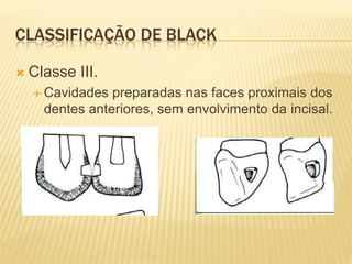 CLASSIFICAÇÃO DE BLACK

   Classe III.
     Cavidades  preparadas nas faces proximais dos
      dentes anteriores, sem envolvimento da incisal.
 