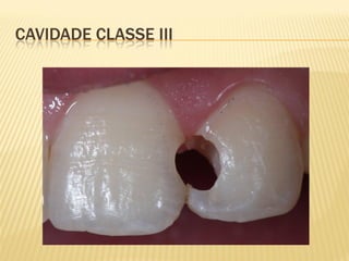 CAVIDADE CLASSE III
 