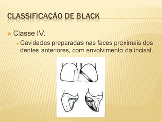 CLASSIFICAÇÃO DE BLACK

   Classe IV.
     Cavidades  preparadas nas faces proximais dos
      dentes anteriores, com envolvimento da incisal.
 