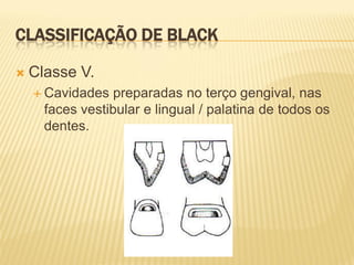 CLASSIFICAÇÃO DE BLACK

   Classe V.
     Cavidades   preparadas no terço gengival, nas
      faces vestibular e lingual / palatina de todos os
      dentes.
 