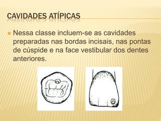 CAVIDADES ATÍPICAS

   Nessa classe incluem-se as cavidades
    preparadas nas bordas incisais, nas pontas
    de cúspide e na face vestibular dos dentes
    anteriores.
 