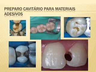 PREPARO CAVITÁRIO PARA MATERIAIS
ADESIVOS
 