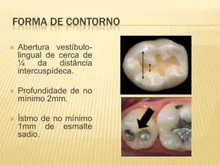 FORMA DE CONTORNO

   Abertura vestíbulo-
    lingual de cerca de
    ¼     da   distância
    intercuspídeca.

   Profundidade de no
    mínimo 2mm.

   Ístmo de no mínimo
    1mm de esmalte
    sadio.
 