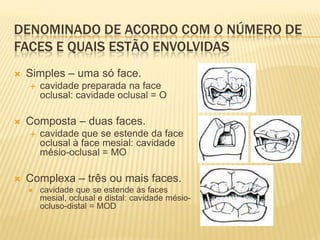 DENOMINADO DE ACORDO COM O NÚMERO DE
FACES E QUAIS ESTÃO ENVOLVIDAS
   Simples – uma só face.
       cavidade preparada na face
        oclusal: cavidade oclusal = O

   Composta – duas faces.
       cavidade que se estende da face
        oclusal à face mesial: cavidade
        mésio-oclusal = MO

   Complexa – três ou mais faces.
       cavidade que se estende às faces
        mesial, oclusal e distal: cavidade mésio-
        ocluso-distal = MOD
 