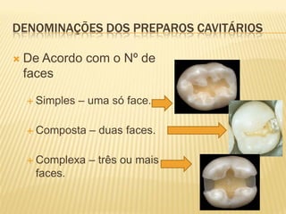 DENOMINAÇÕES DOS PREPAROS CAVITÁRIOS

   De Acordo com o Nº de
    faces

     Simples   – uma só face.

     Composta    – duas faces.

     Complexa    – três ou mais
     faces.
 
