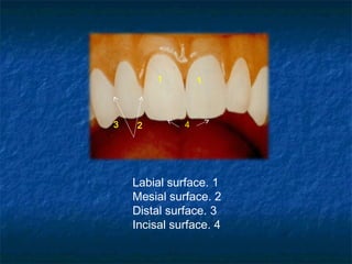 1        1



3   2         4




    Labial surface. 1
    Mesial surface. 2
    Distal surface. 3
    Incisal surface. 4
 