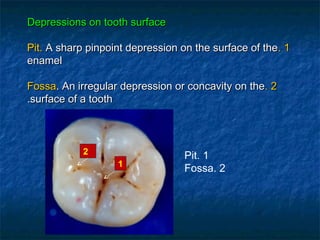 Depressions on tooth surface

Pit. A sharp pinpoint depression on the surface of the. 1
enamel

Fossa. An irregular depression or concavity on the. 2
.surface of a tooth



            2                     Pit. 1
                   1
                                  Fossa. 2
 