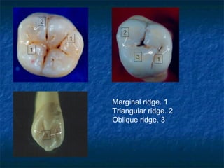 2
                   2
            1

1
                       3      1




                Marginal ridge. 1
                Triangular ridge. 2
                Oblique ridge. 3

        1
 