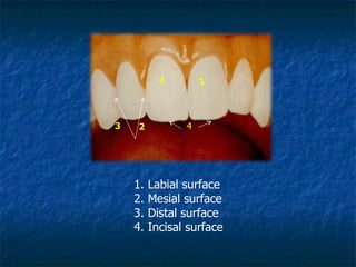 4 3 2 1 1 1. Labial surface 2. Mesial surface 3. Distal surface 4. Incisal surface 