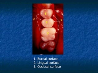 3 3 3 2 1 1. Buccal surface 2. Lingual surface 3. Occlusal surface 
