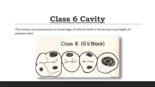 Nomenclature in operative dentistry | PPTX
