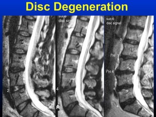 Nomenclature in spine mri | PPT