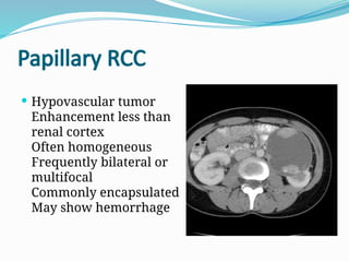 Papillary Rcc Radiopaedia Nomenclature of Renal Cell Carcinoma and its Reasoning | PPTX