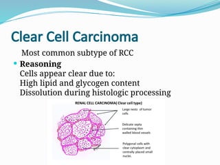 Nomenclature of Renal Cell Carcinoma and its Reasoning | PPTX