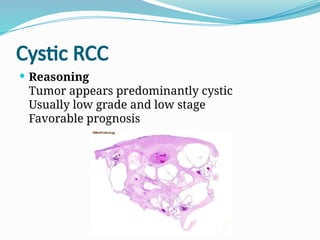 Nomenclature of Renal Cell Carcinoma and its Reasoning | PPTX