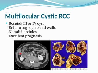 Nomenclature of RCC according to its histopathology.pptx