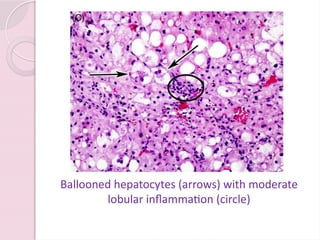 Non-alcoholic Fatty Liver Disease...pptx