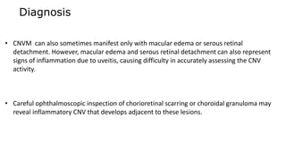 Diagnosis
• CNVM can also sometimes manifest only with macular edema or serous retinal
detachment. However, macular edema and serous retinal detachment can also represent
signs of inflammation due to uveitis, causing difficulty in accurately assessing the CNV
activity.
• Careful ophthalmoscopic inspection of chorioretinal scarring or choroidal granuloma may
reveal inflammatory CNV that develops adjacent to these lesions.
 
