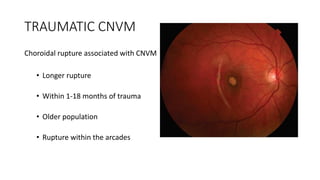 TRAUMATIC CNVM
Choroidal rupture associated with CNVM
• Longer rupture
• Within 1-18 months of trauma
• Older population
• Rupture within the arcades
 