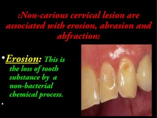 Non carious  cervical lesion
