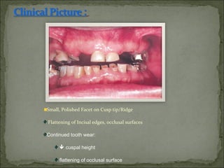 Cuspal Ridges Non carious lesions of teeth | PPT