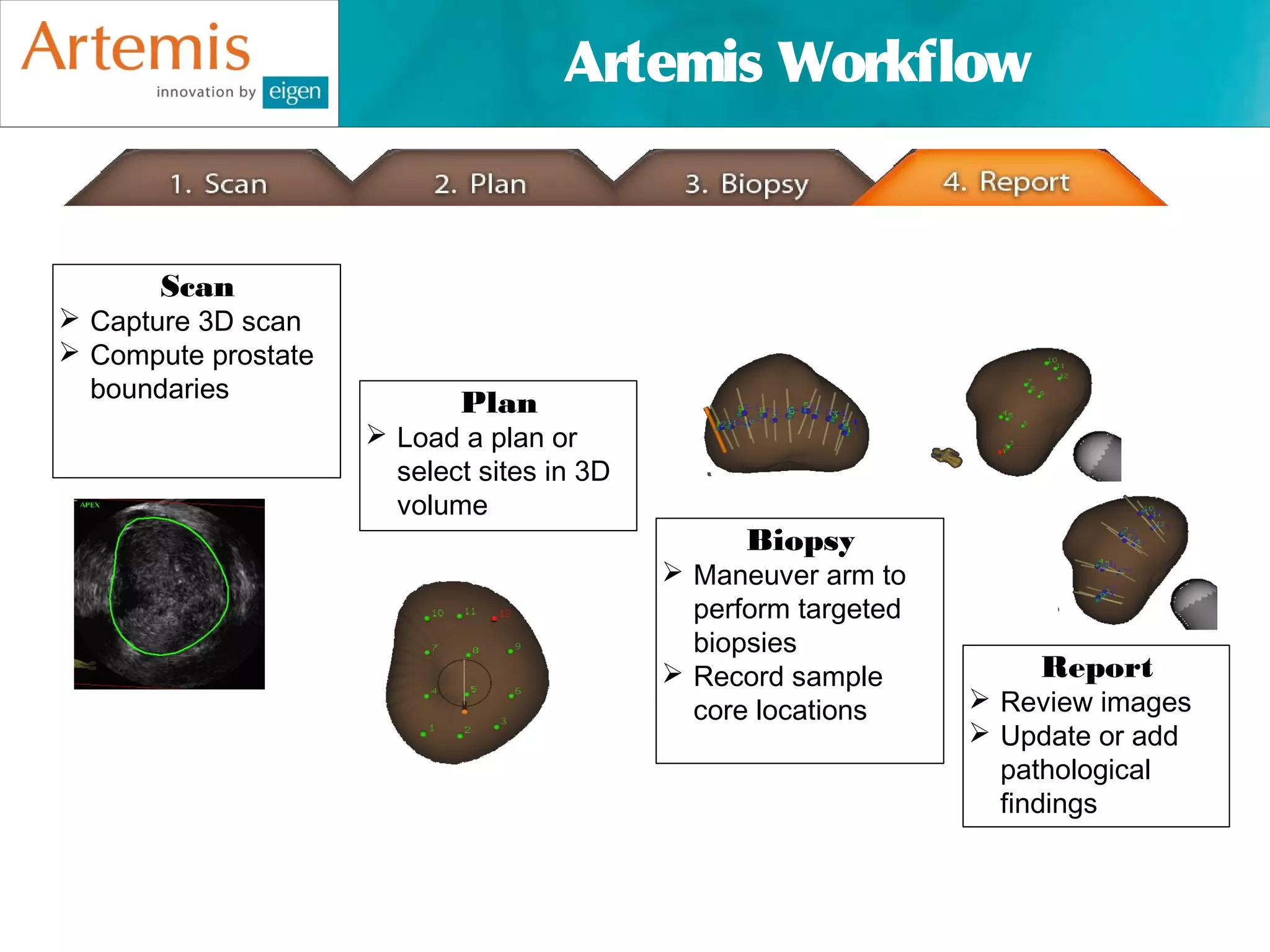 Artemis Workflow


       Scan
 Capture 3D scan
 Compute prostate
  boundaries
                            Plan
                      Load a plan or
                       select sites in 3D
                       volume
                                                  Biopsy
                                             Maneuver arm to
                                              perform targeted
                                              biopsies
                                             Record sample          Report
                                              core locations      Review images
                                                                  Update or add
                                                                   pathological
                                                                   findings
 