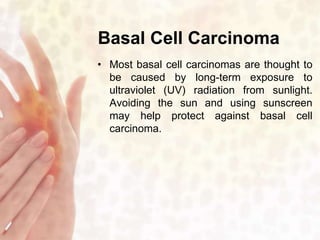 Basal Cell Carcinoma 
• Most basal cell carcinomas are thought to 
be caused by long-term exposure to 
ultraviolet (UV) radiation from sunlight. 
Avoiding the sun and using sunscreen 
may help protect against basal cell 
carcinoma. 
 
