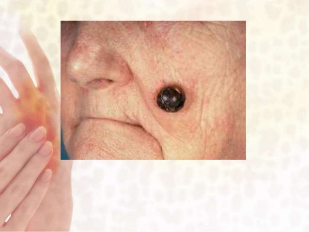 Non contagious skin disorders