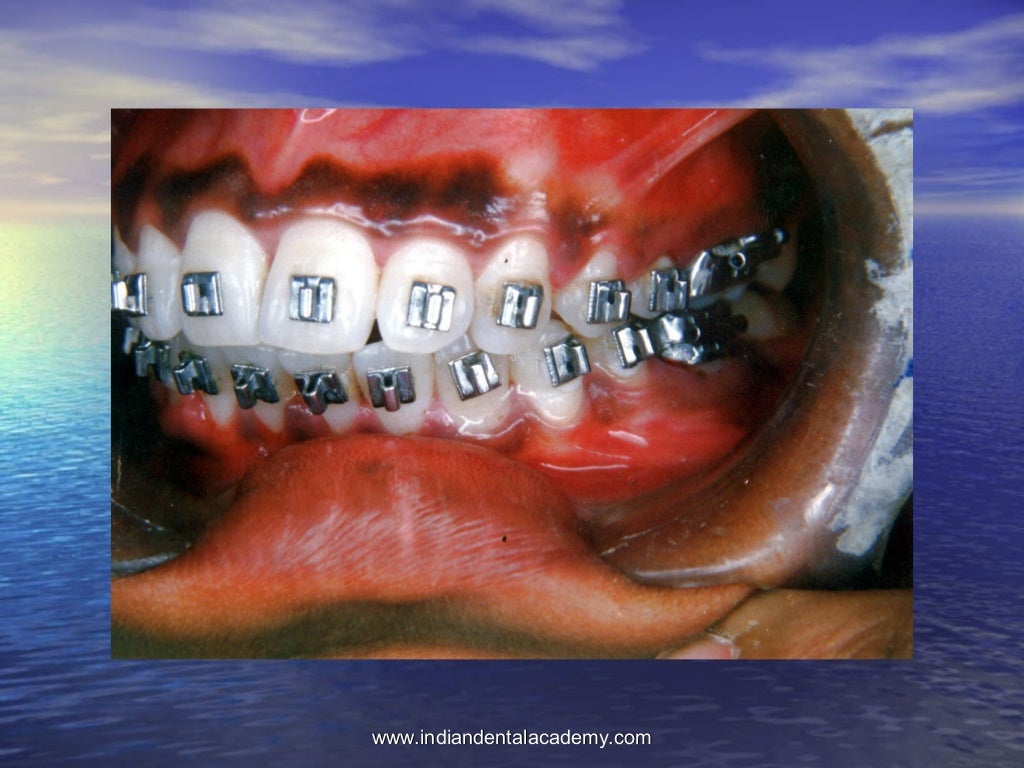 Non extraction treatment modality /certified fixed orthodontic course…