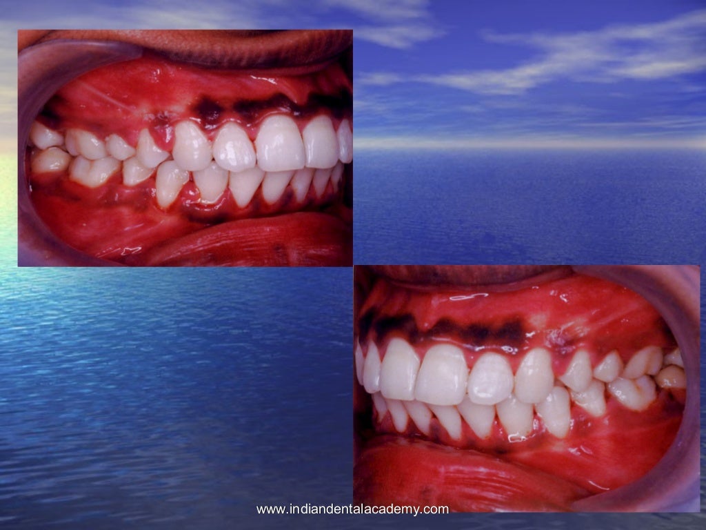 Non extraction treatment modality /certified fixed orthodontic course…