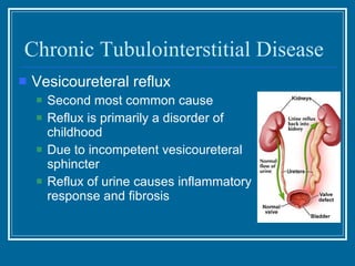 Chronic Tubulointerstitial Disease Vesicoureteral reflux Second most common cause Reflux is primarily a disorder of childhood Due to incompetent vesicoureteral sphincter Reflux of urine causes inflammatory response and fibrosis 