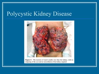 Polycystic Kidney Disease 