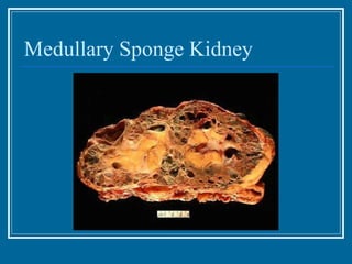 Medullary Sponge Kidney 